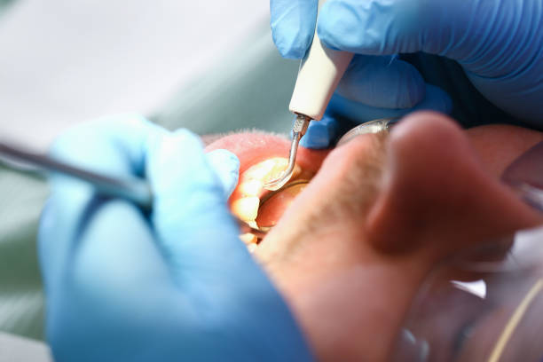 Best Emergency Wisdom Teeth Removal in Old Hill, CT