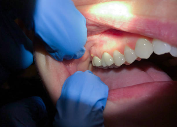 Best Emergency Tooth Extraction in Old Hill, CT